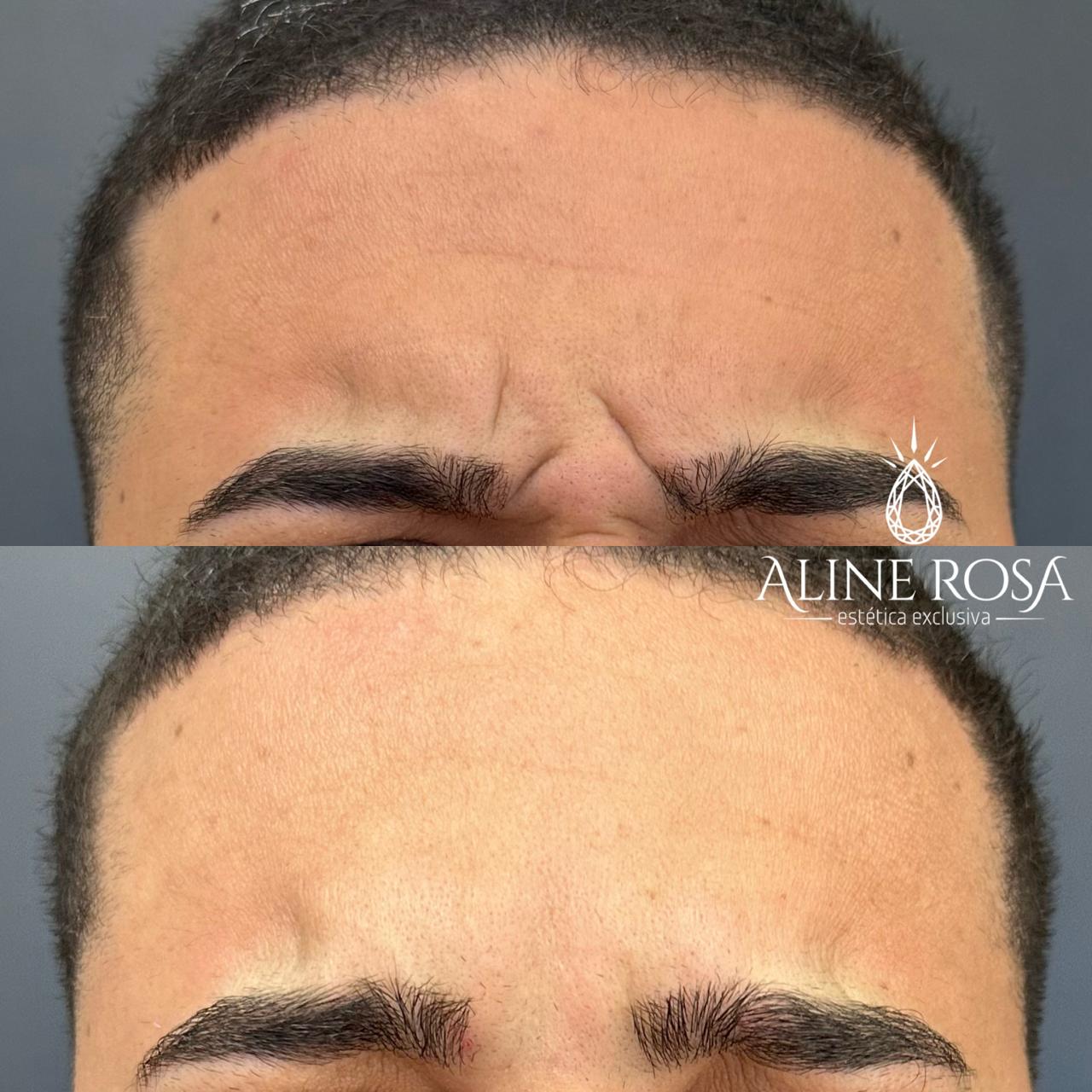 Botox Masculino